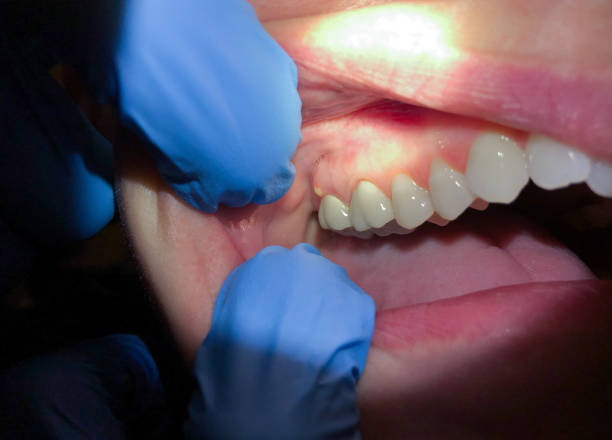 Best Dentist for Tooth Abscess  in Saxon, SC